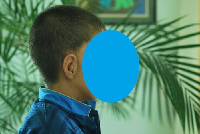 ear prosthesis